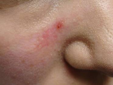 surg scar R cheek