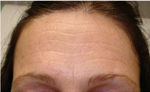 Forehead Botox