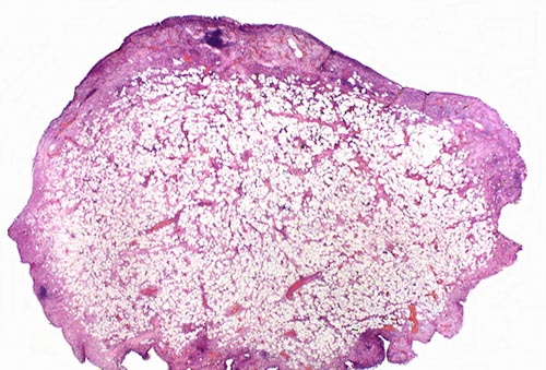 lipoma histology